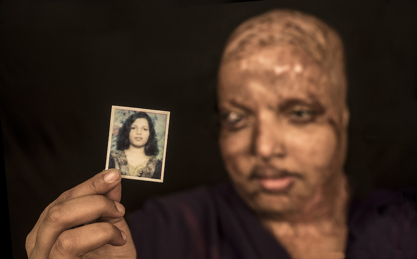 ACID ATTACK SURVIVOR FINDS LOVE