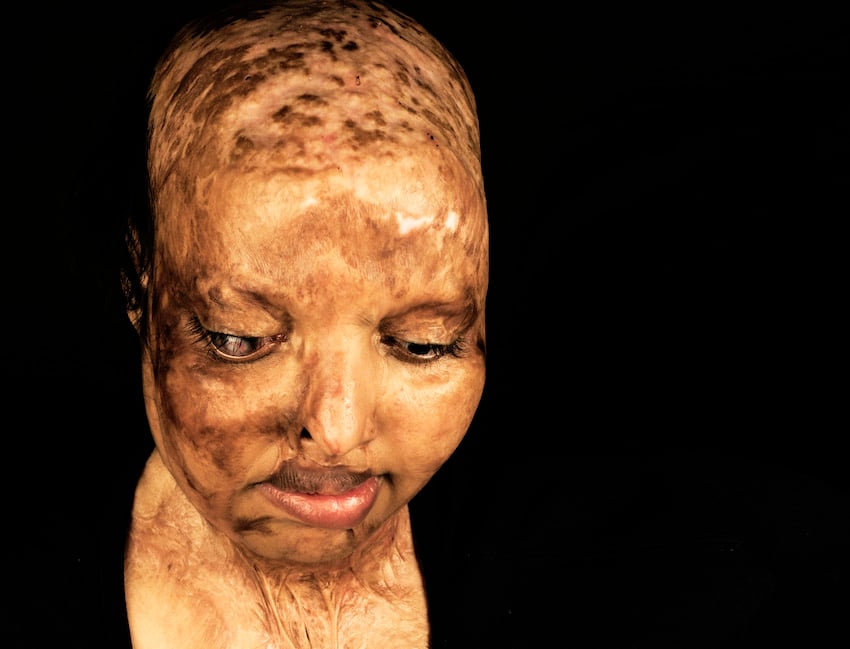 ACID ATTACK SURVIVOR FINDS LOVE
