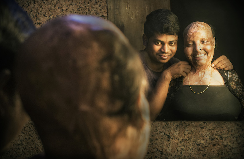ACID ATTACK SURVIVOR FINDS LOVE