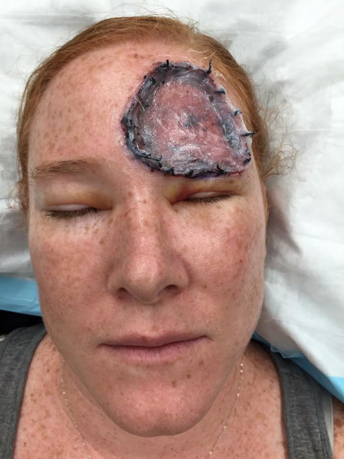 skin-cancer-melanoma-photo-diary-bethany-greenway-4-5993eb0c8fc3e__700.jpg