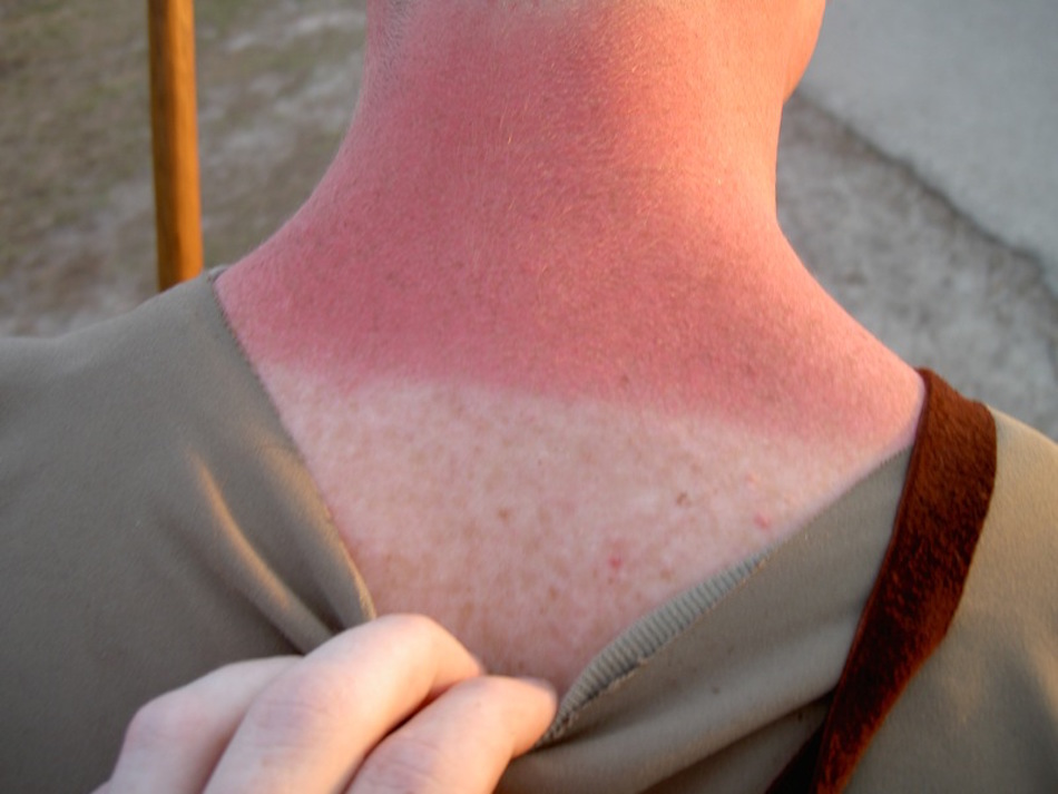 sunburn.jpg