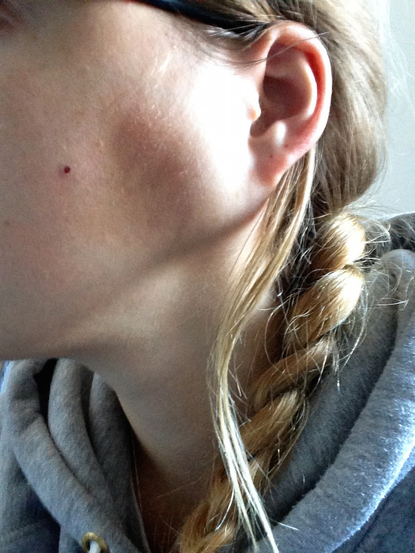 WISDOM TOOTH CANCER