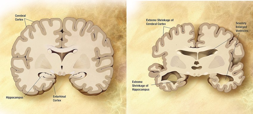 2048px-Alzheimers_disease_brain_comparison.jpg