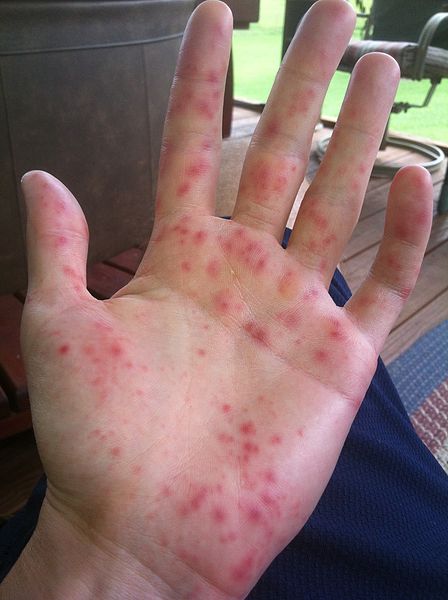 448px-Hand_Foot_and_Mouth_Disease_Blisters.jpeg
