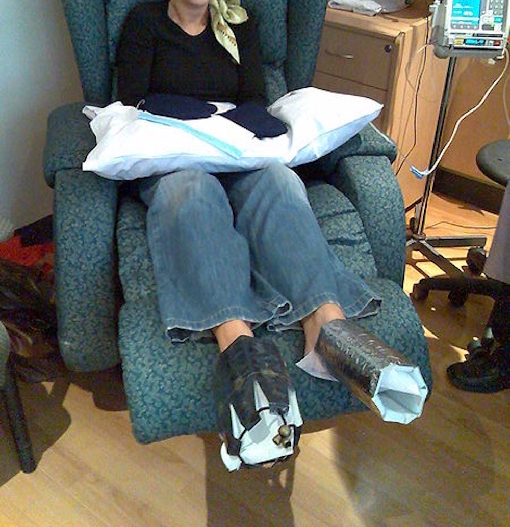 450px-Chemotherapy_with_acral_cooling.jpg