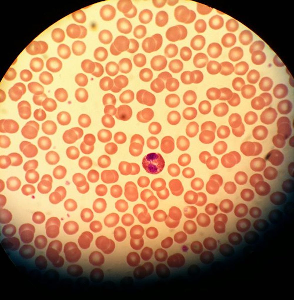 Eosinophil_Red_Blood_Cells_Platelets.jpg