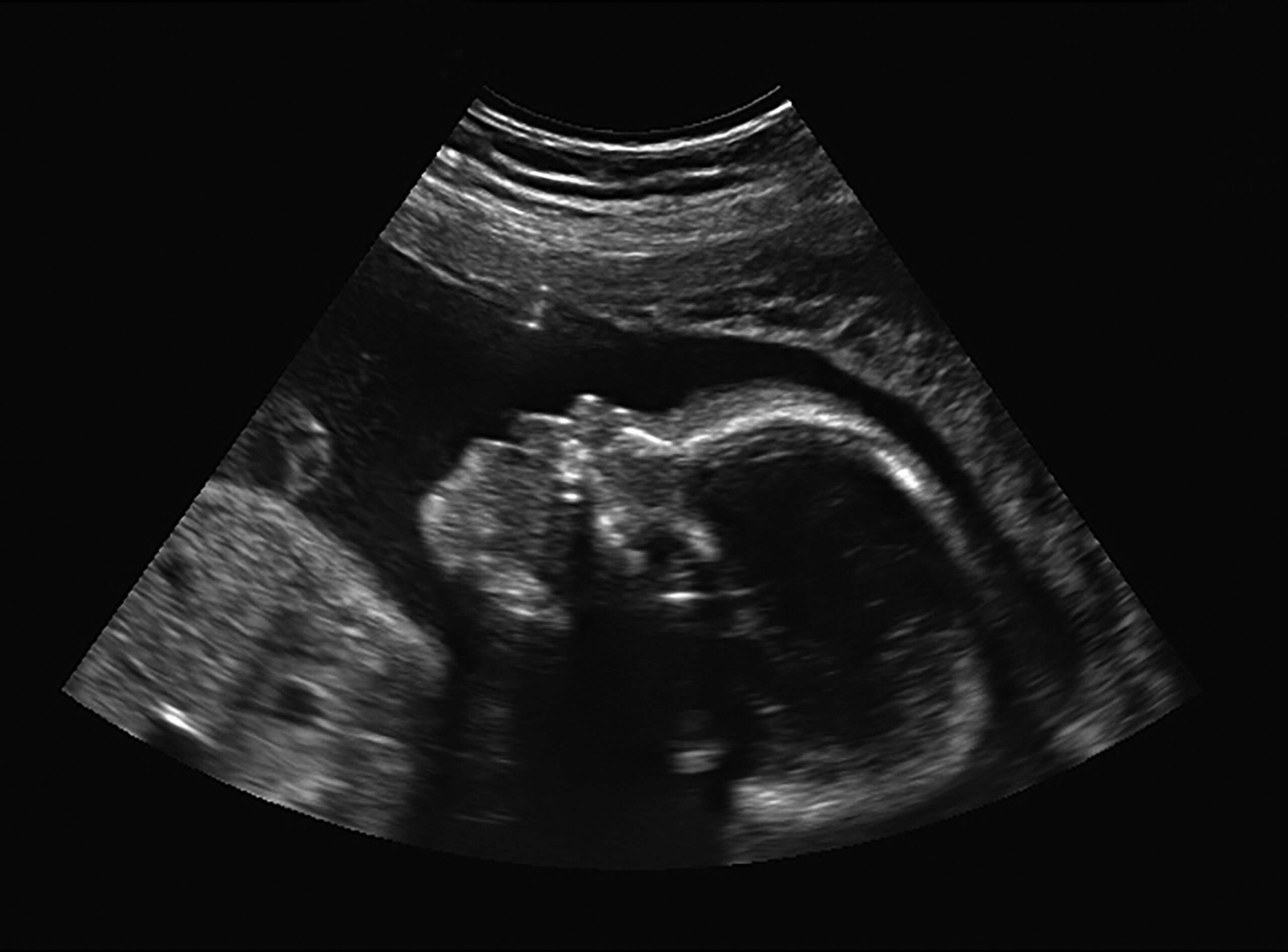 ultrasound of baby in pregnant woman