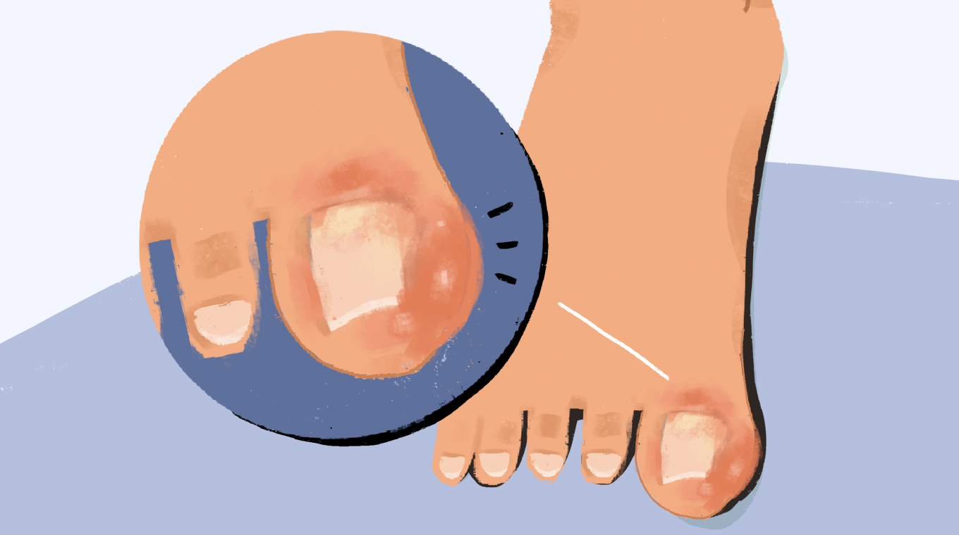 IMAGE_6_Swollen_Big_Toe.jpg