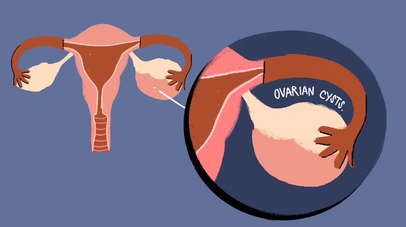 LT_Ovarian_Cysts_02.jpg