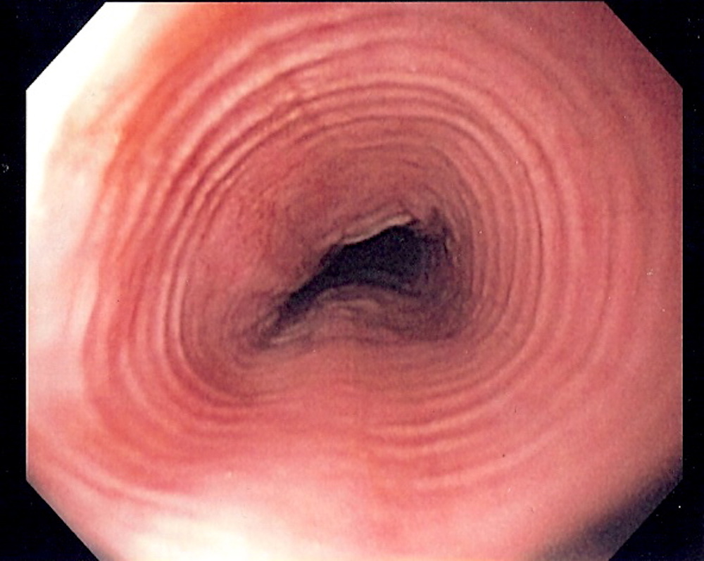 Multi_ring_esophagus.jpg