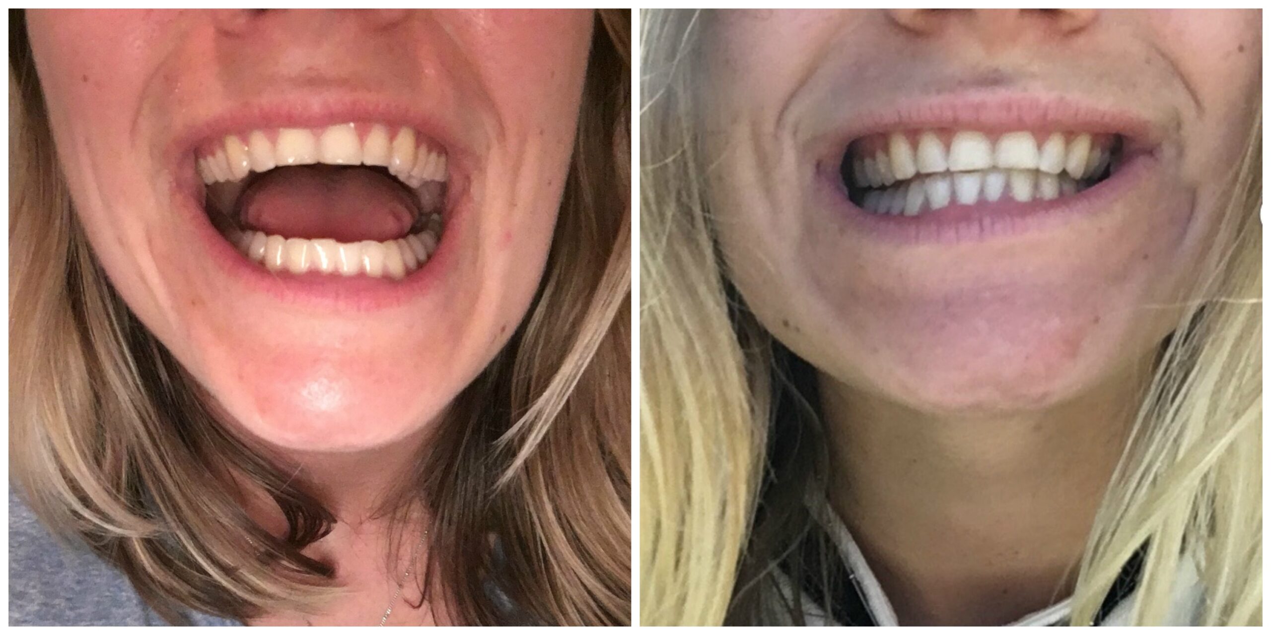 TeethBefore-After.jpg