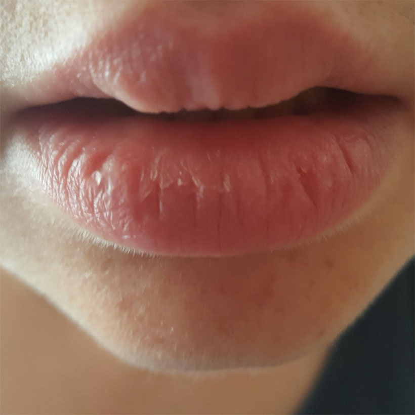 chapped-lips-1.jpg