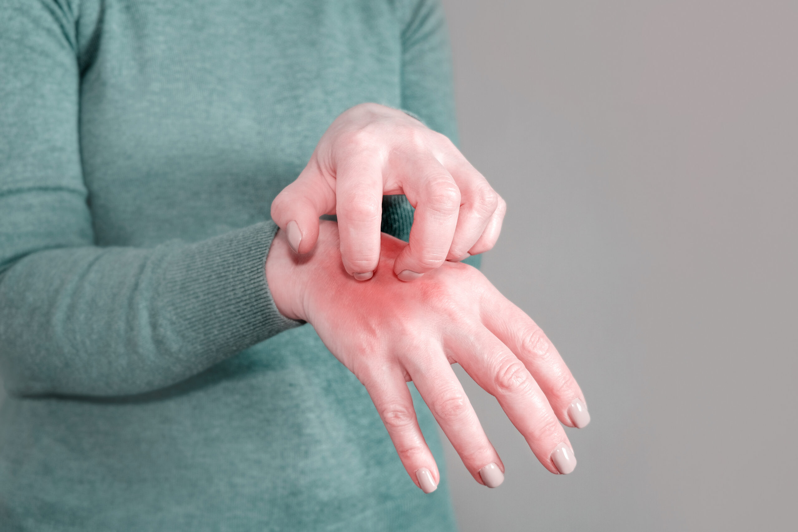 The girl in the gray jumper scratches her hand. Scabies. Inflammation of the skin. Disease of the skin on the hand, the manifestation of dermatitis