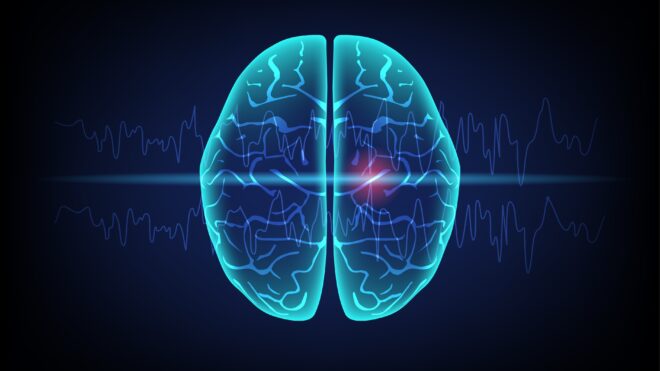 Seizure in human brain