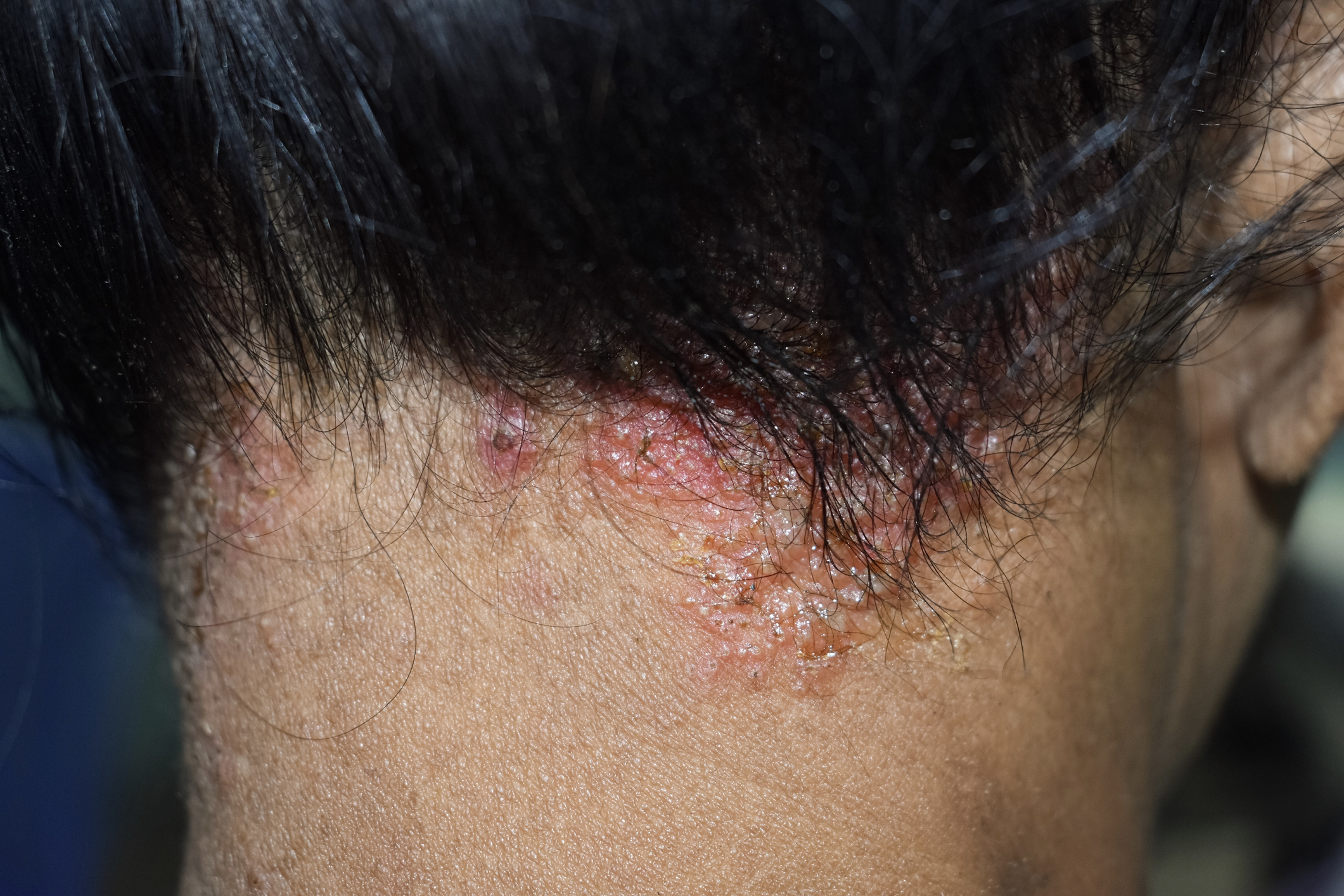 Seborrheic dermatitis or fungal skin infection at the scalp of Southeast Asian, Myanmar adult female patient.