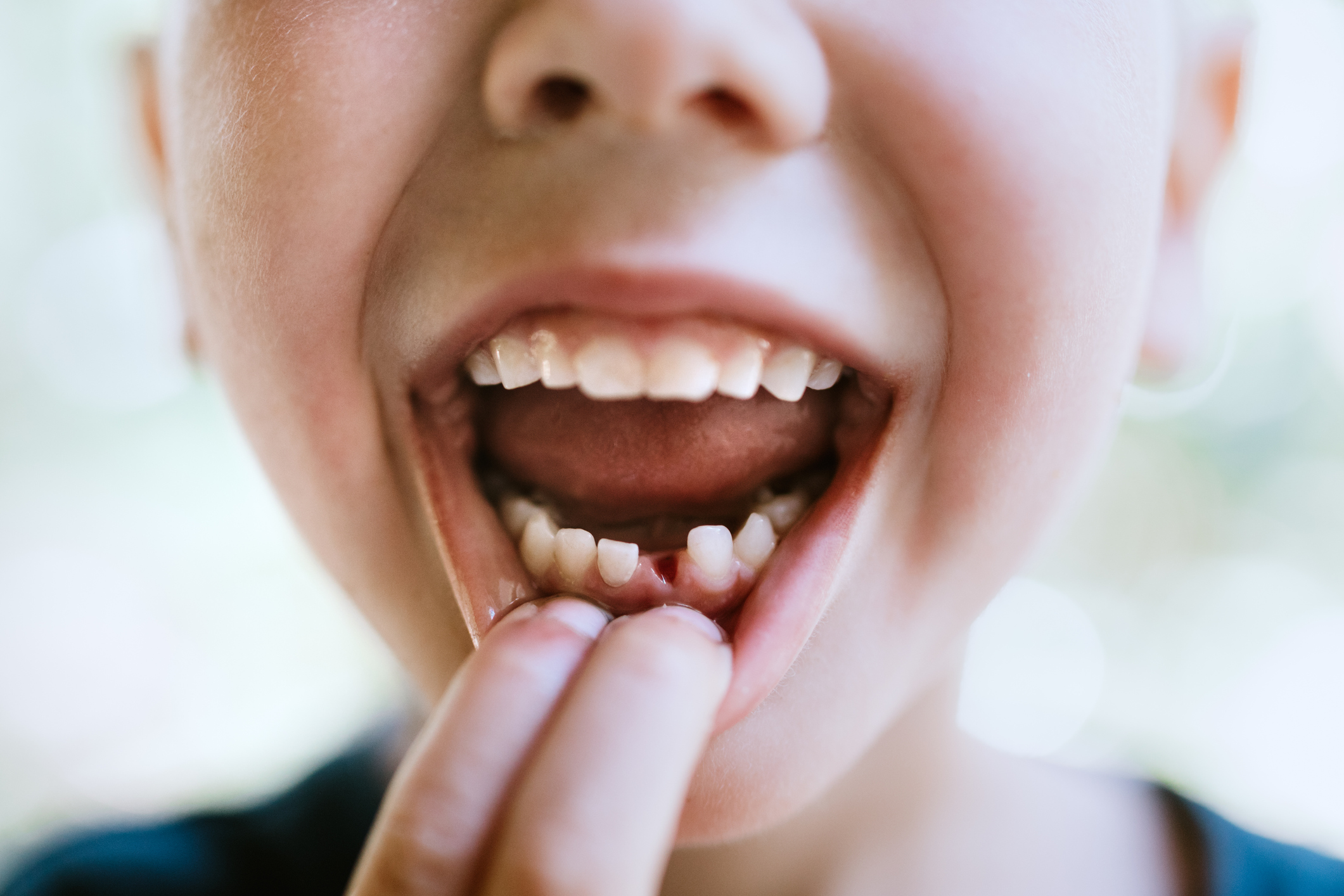 Child with First Lost Tooth