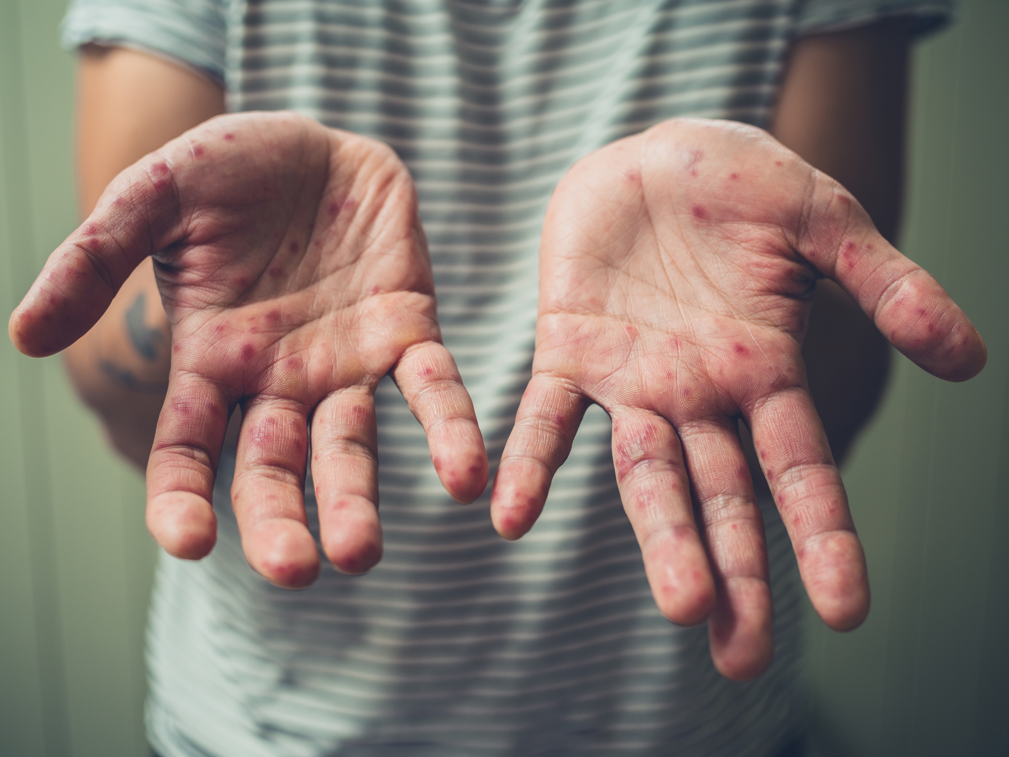 Young man with hand foot and mouth disease