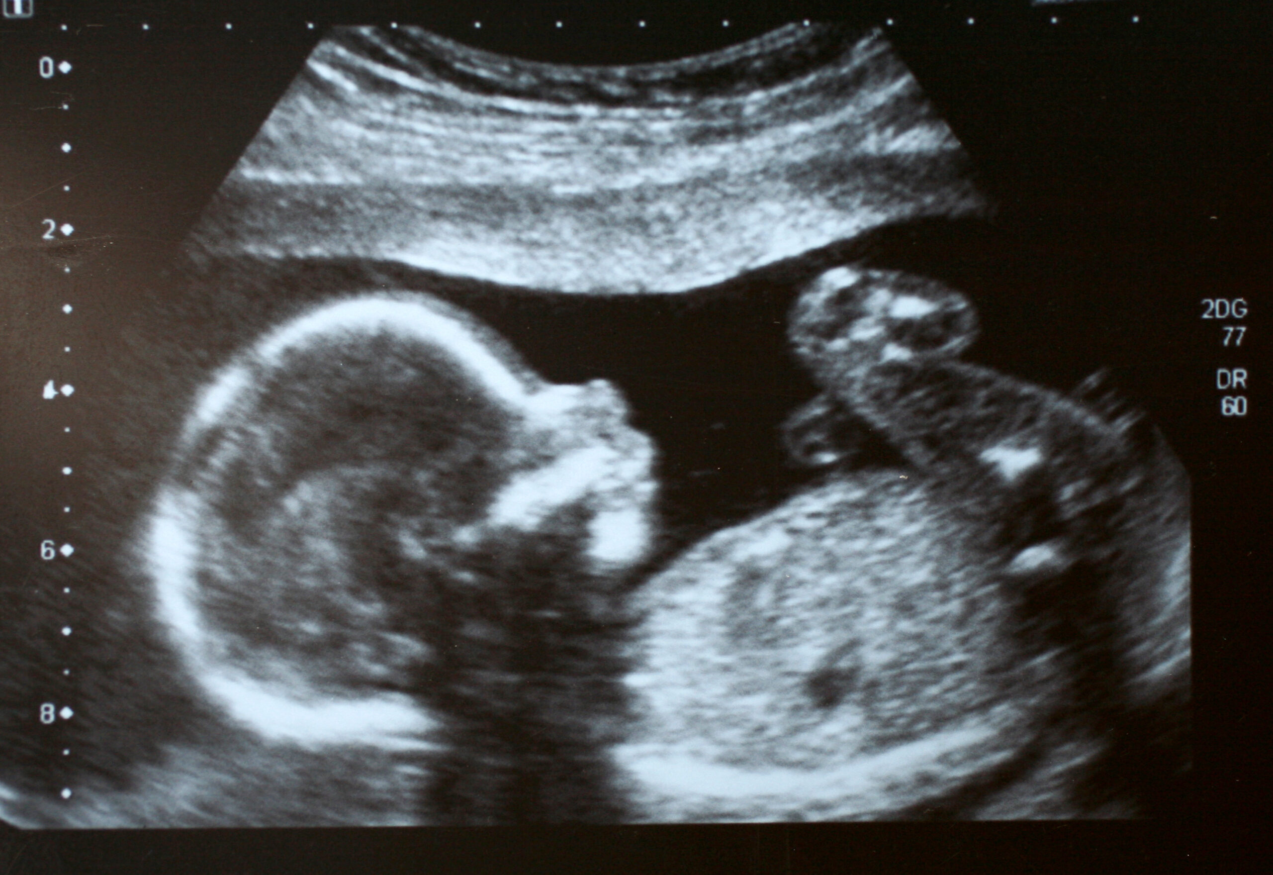 Foetus ultrasound