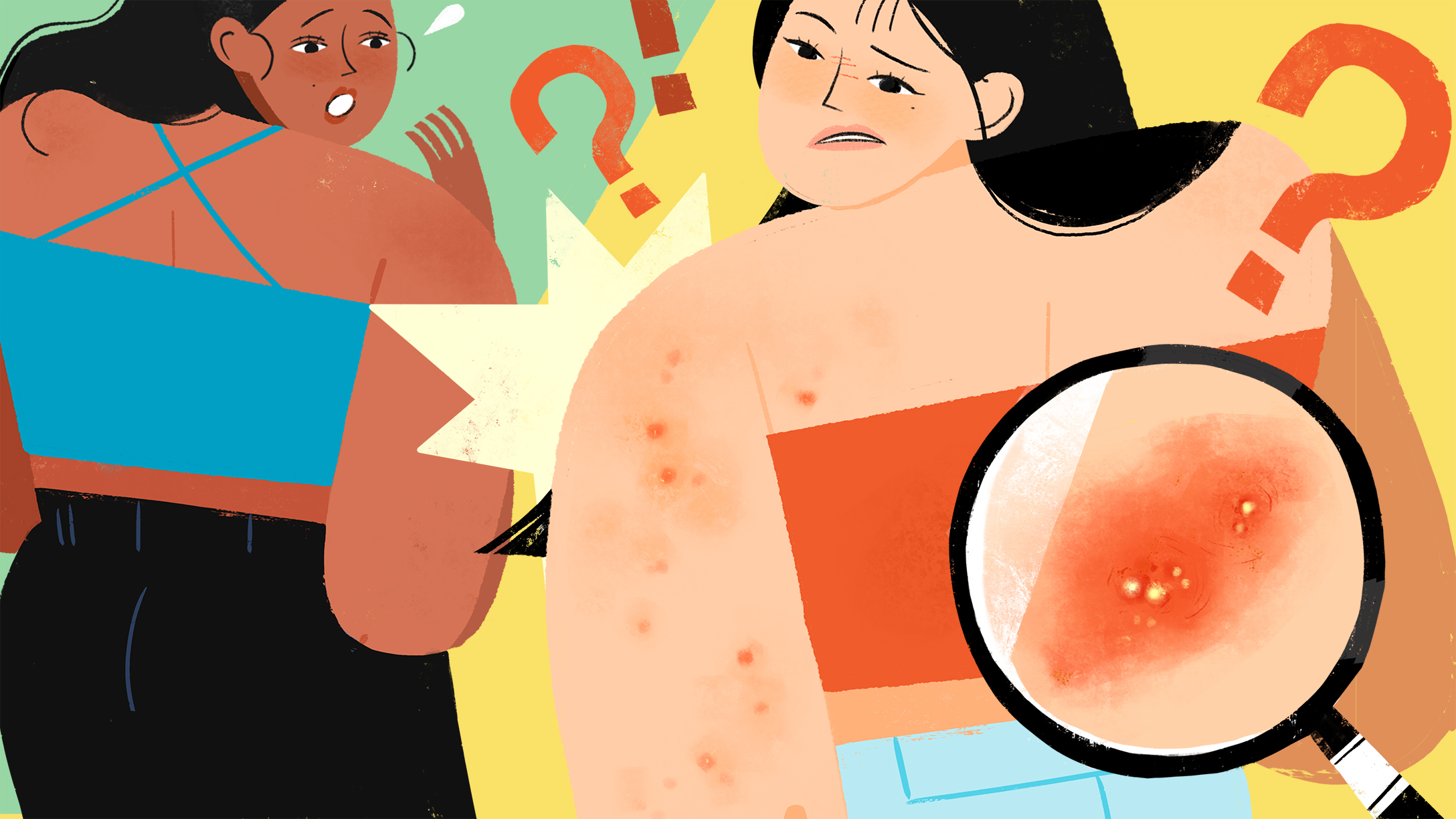 MRSA symptoms